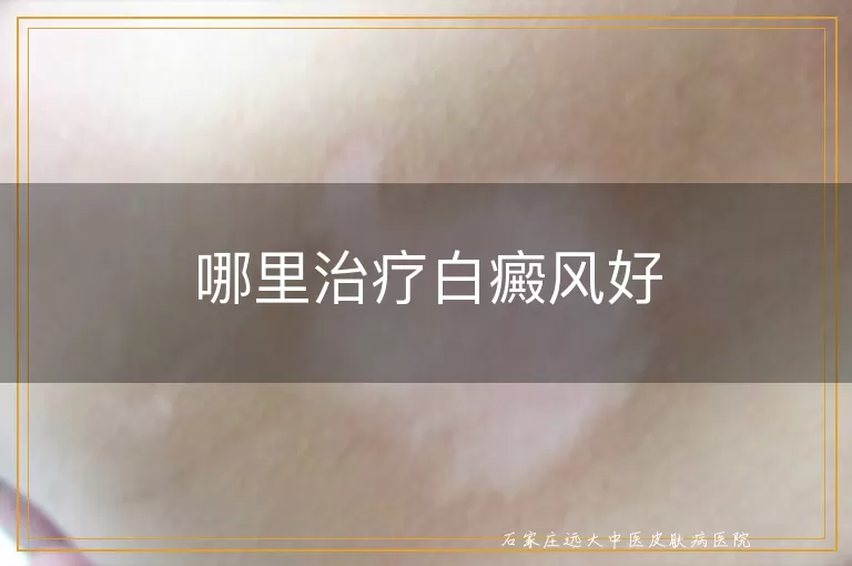 哪里治疗白癜风好