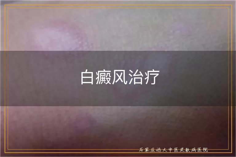 白癜风治疗