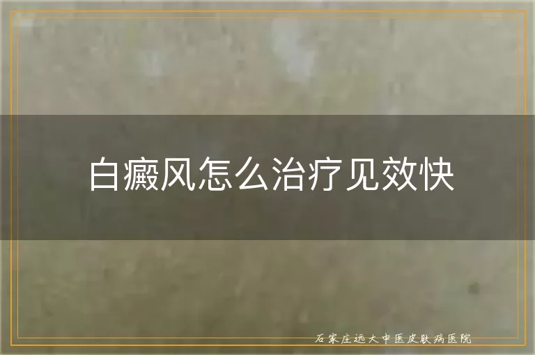 白癜风怎么治疗见效快