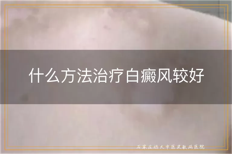 什么方法治疗白癜风较好