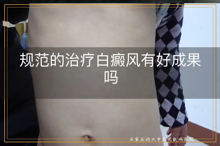 规范的治疗白癜风有好成果吗