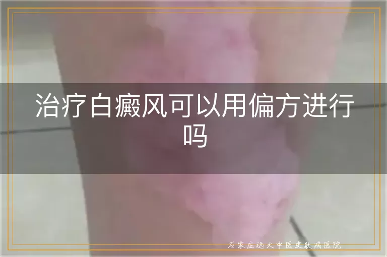 治疗白癜风可以用偏方进行吗