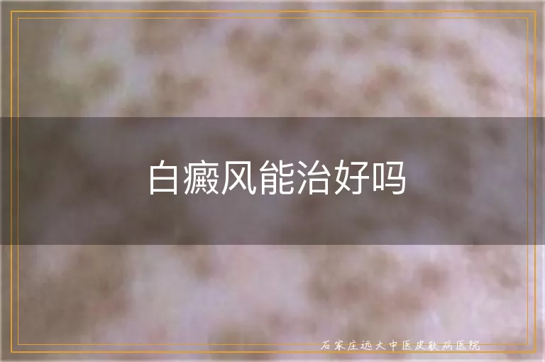 白癜风能治好吗