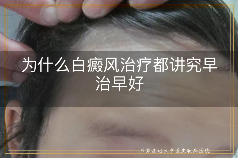 为什么白癜风治疗都讲究早治早好