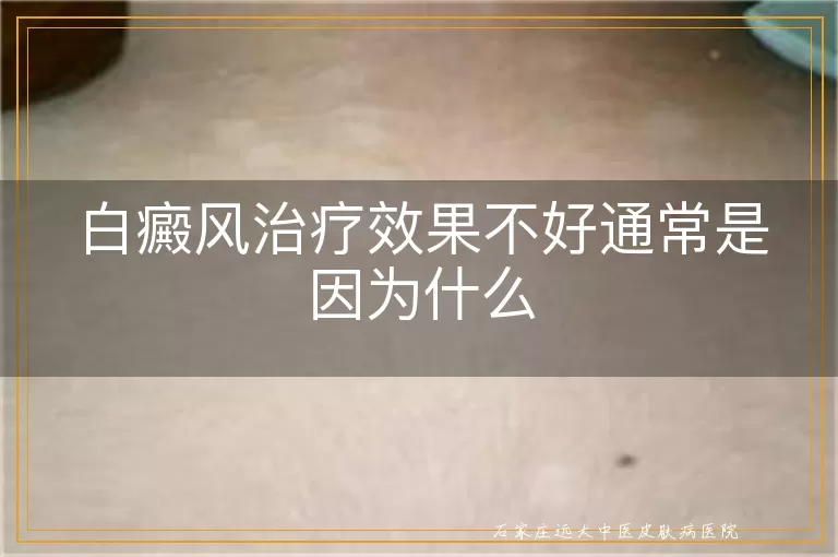 白癜风治疗效果不好通常是因为什么