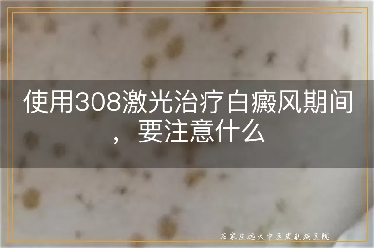 使用308激光治疗白癜风期间，要注意什么