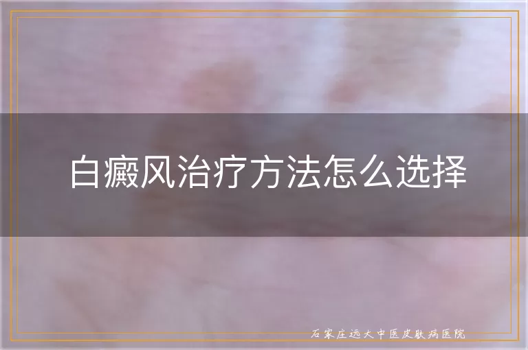 白癜风治疗方法怎么选择