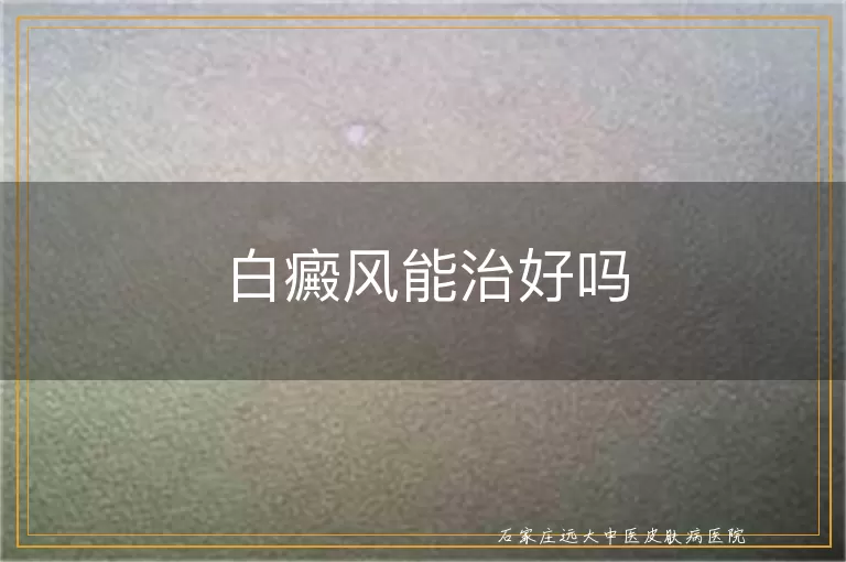 白癜风能治好吗