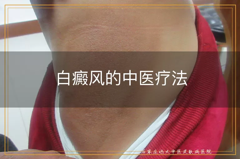 白癜风的中医疗法