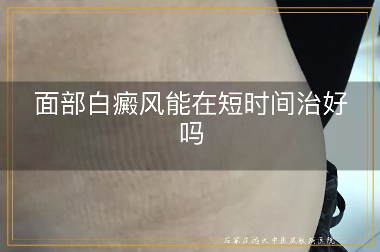 面部白癜风能在短时间治好吗