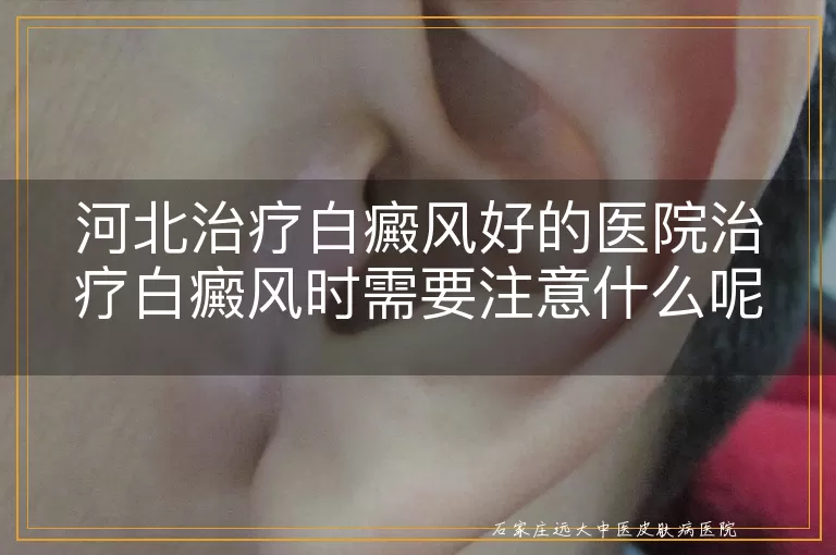 河北治疗白癜风好的医院治疗白癜风时需要注意什么呢