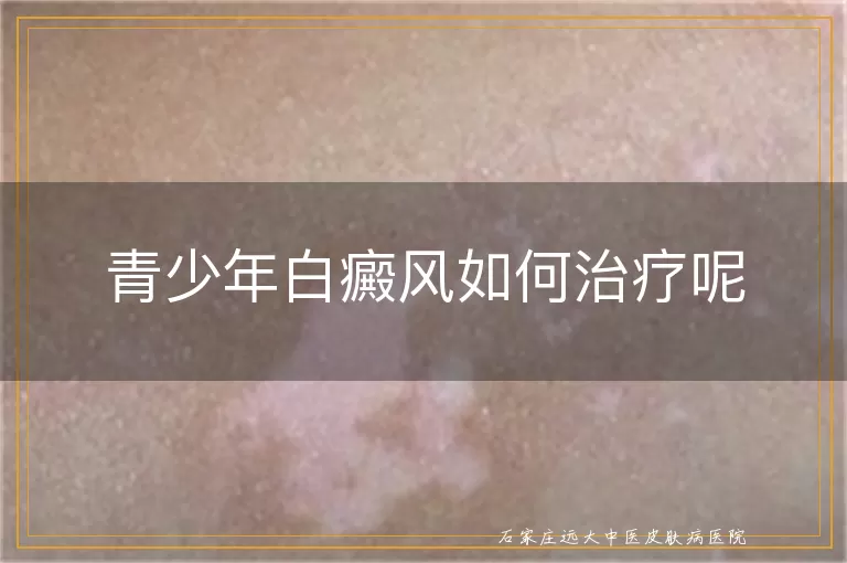 青少年白癜风如何治疗呢