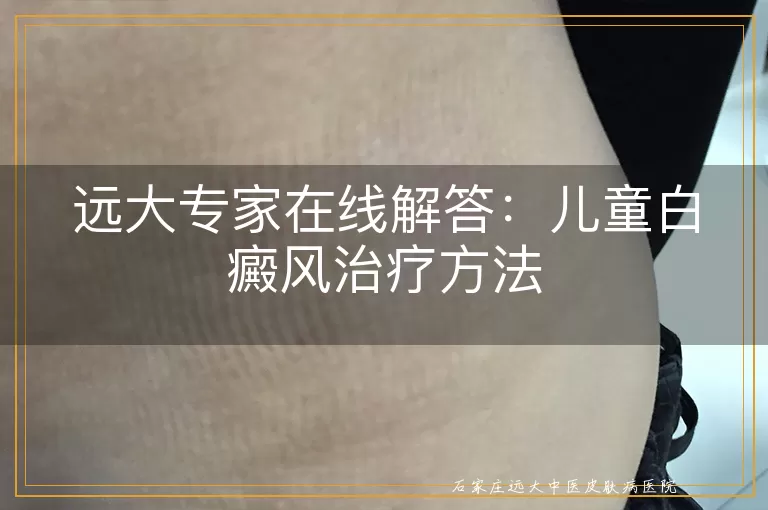 远大专家在线解答：儿童白癜风治疗方法