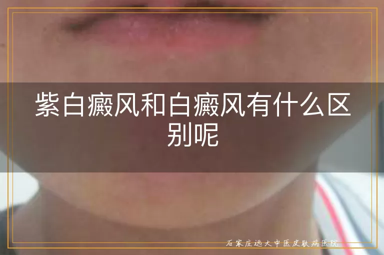 紫白癜风和白癜风有什么区别呢
