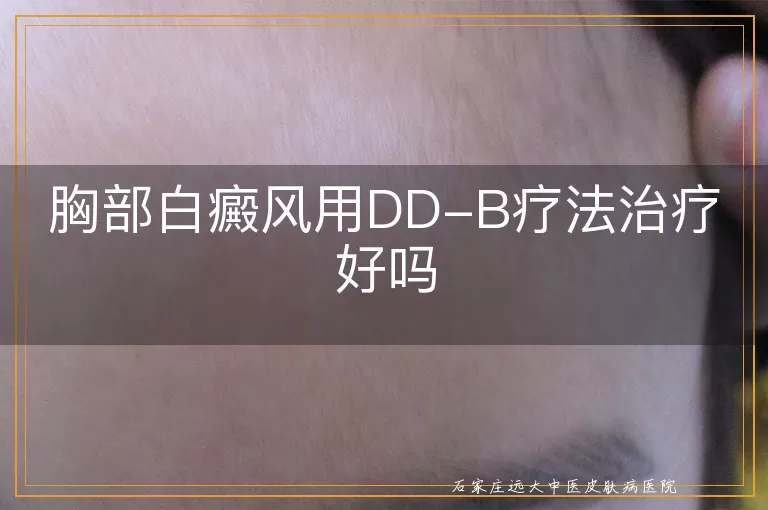 胸部白癜风用DD-B疗法治疗好吗