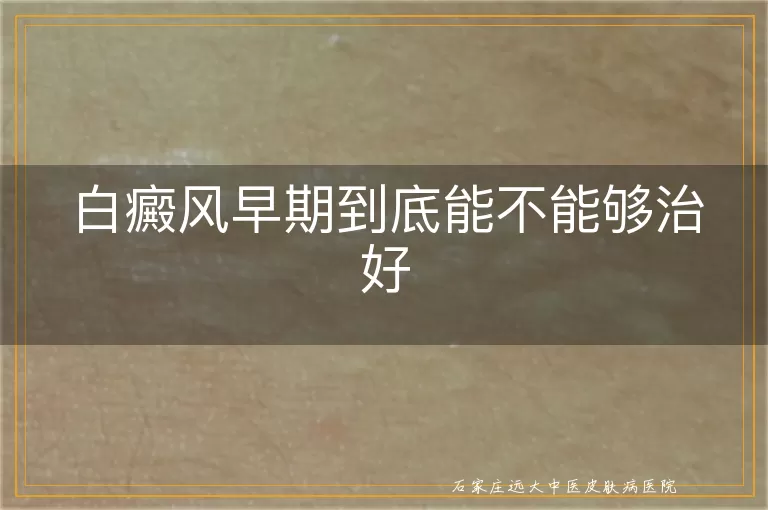 白癜风早期到底能不能够治好