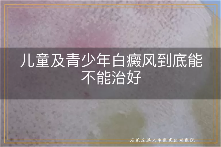 儿童及青少年白癜风到底能不能治好