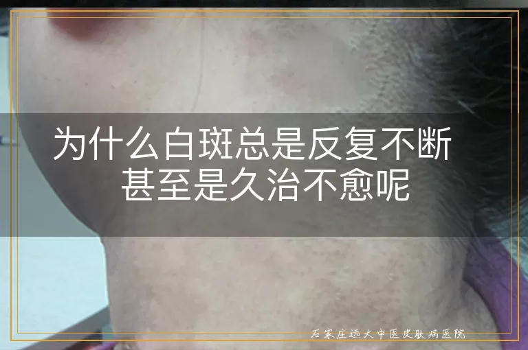 为什么白斑总是反复不断  甚至是久治不愈呢