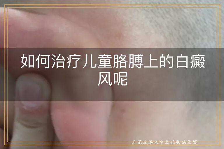 如何治疗儿童胳膊上的白癜风呢