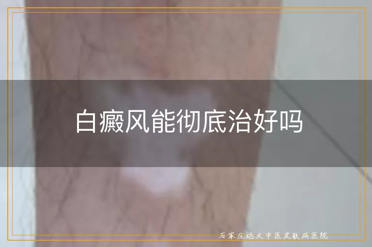 白癜风能彻底治好吗