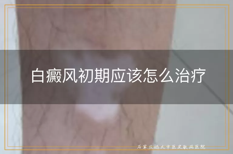 白癜风初期应该怎么治疗