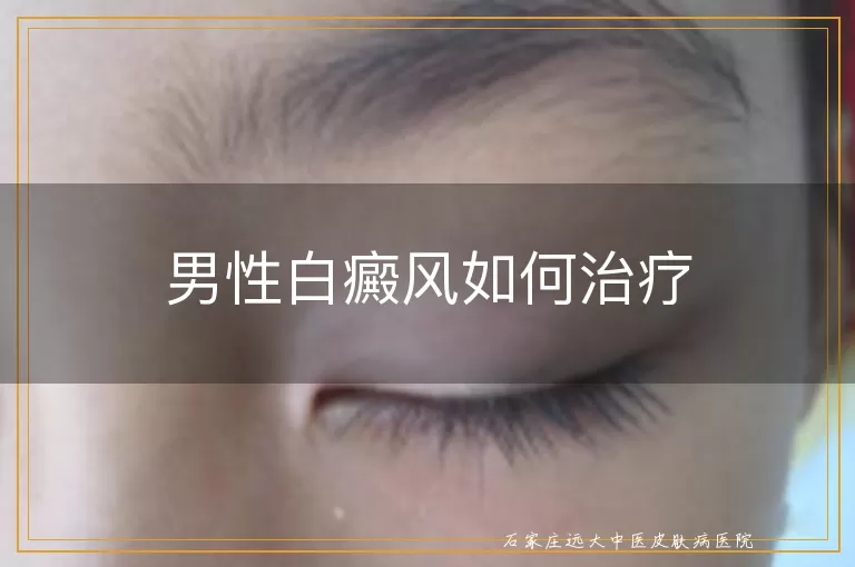 男性白癜风如何治疗