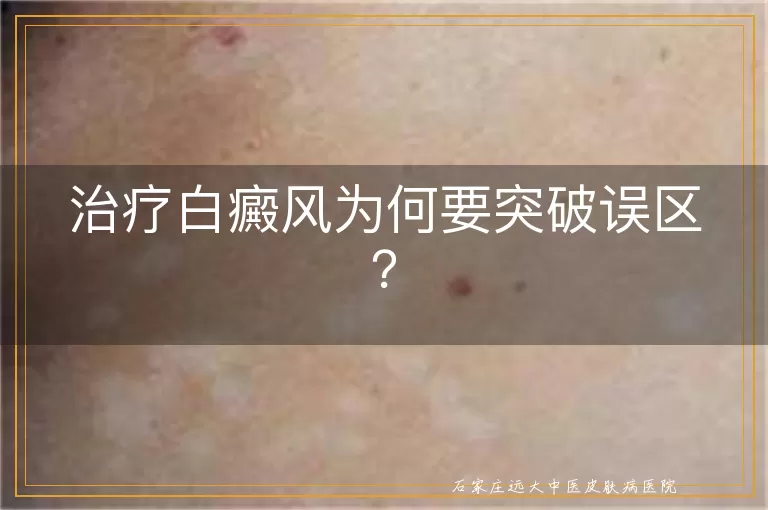 治疗白癜风为何要突破误区？