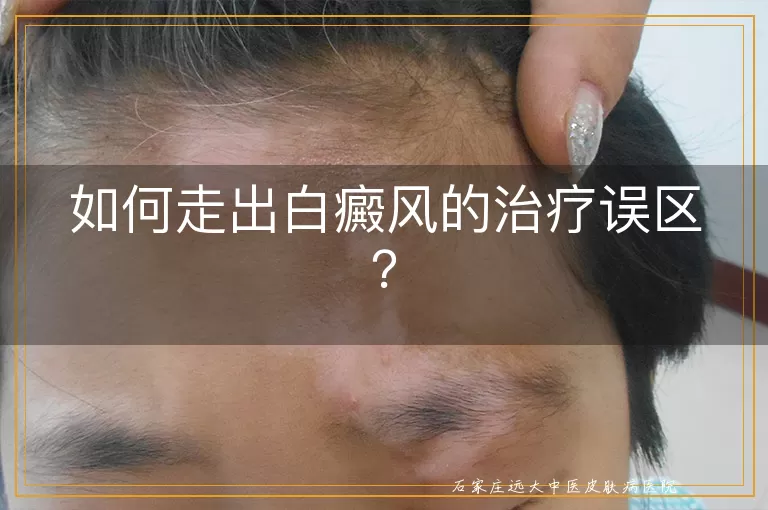 如何走出白癜风的治疗误区？