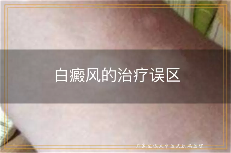 白癜风的治疗误区