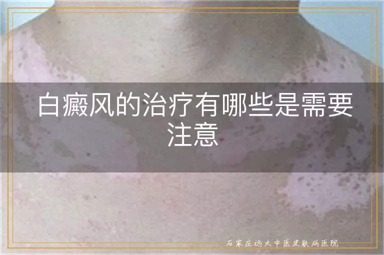白癜风的治疗有哪些是需要注意