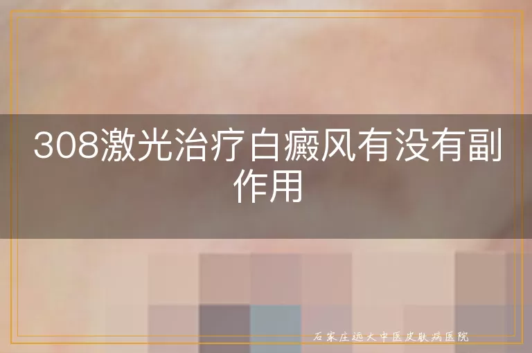 308激光治疗白癜风有没有副作用