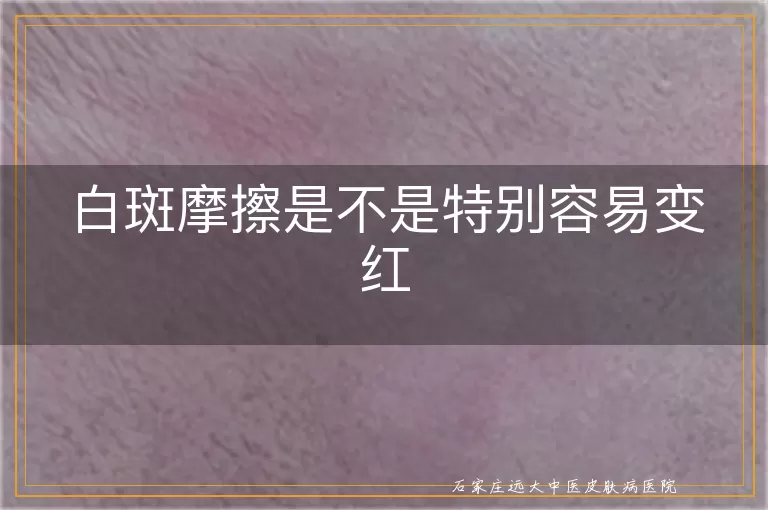 白斑摩擦是不是特别容易变红