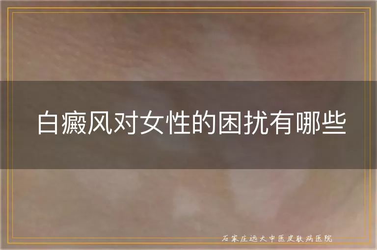 白癜风对女性的困扰有哪些