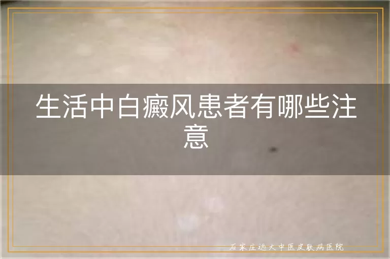 生活中白癜风患者有哪些注意
