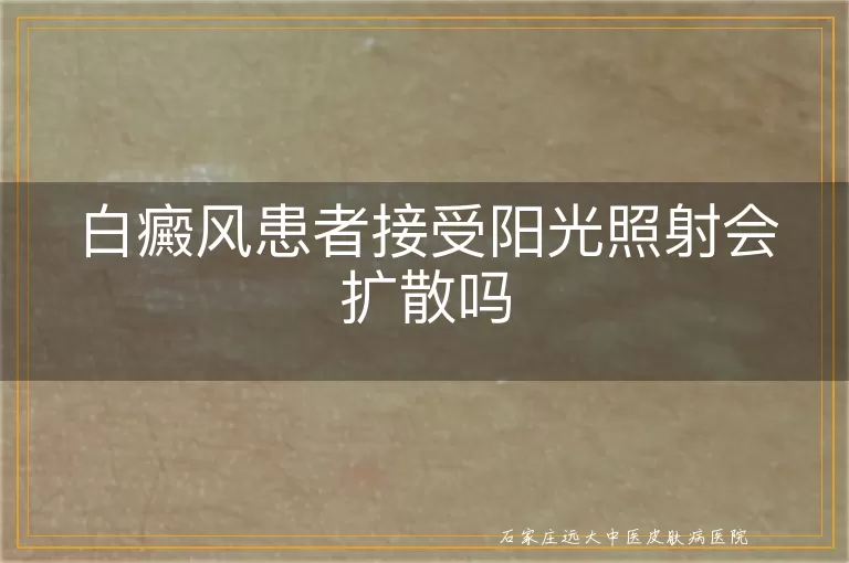 白癜风患者接受阳光照射会扩散吗