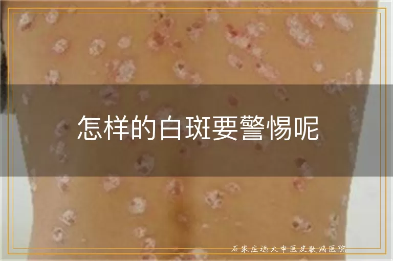 怎样的白斑要警惕呢