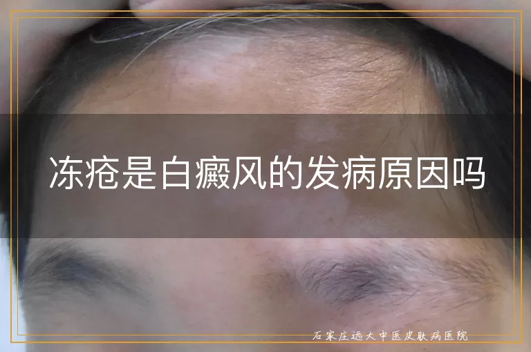 冻疮是白癜风的发病原因吗