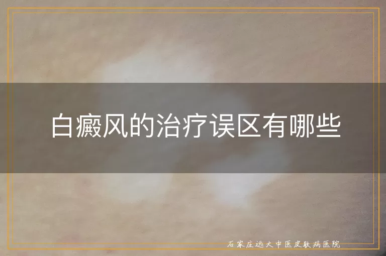 白癜风的治疗误区有哪些