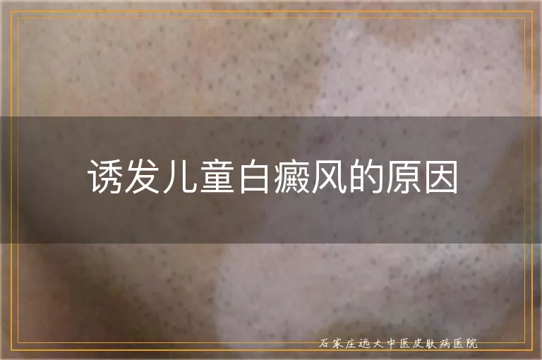 诱发儿童白癜风的原因
