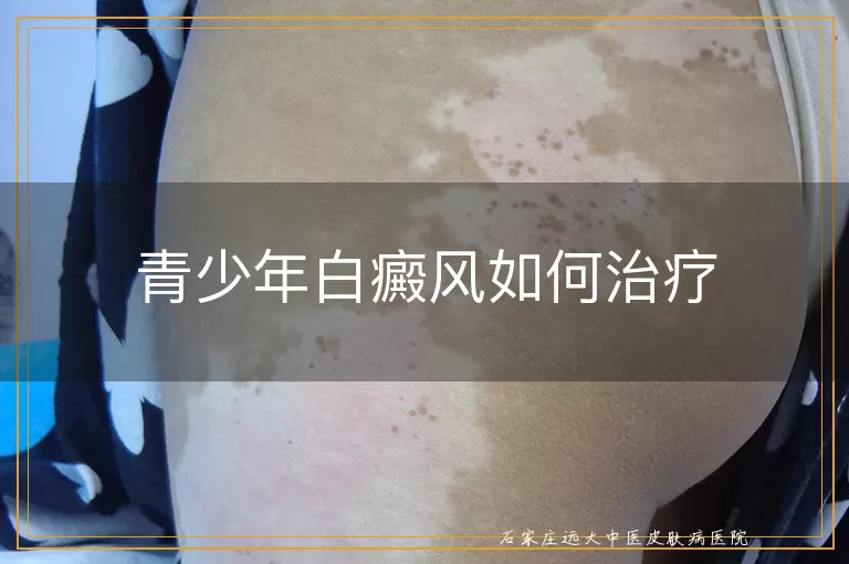 青少年白癜风如何治疗