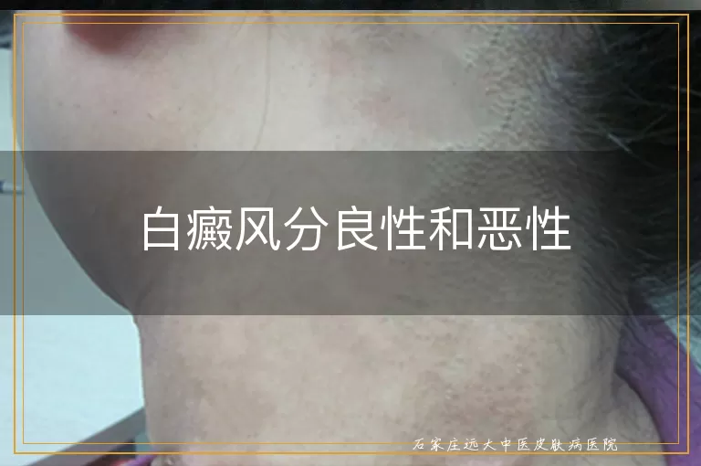 白癜风分良性和恶性