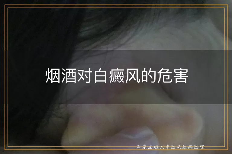 烟酒对白癜风的危害