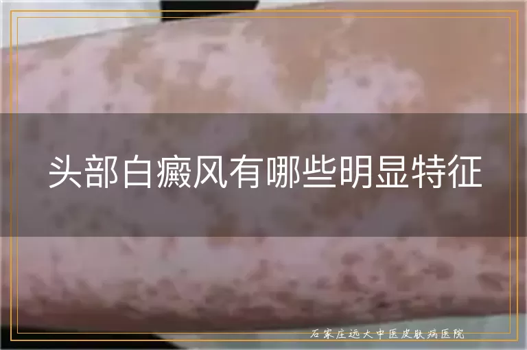 头部白癜风有哪些明显特征