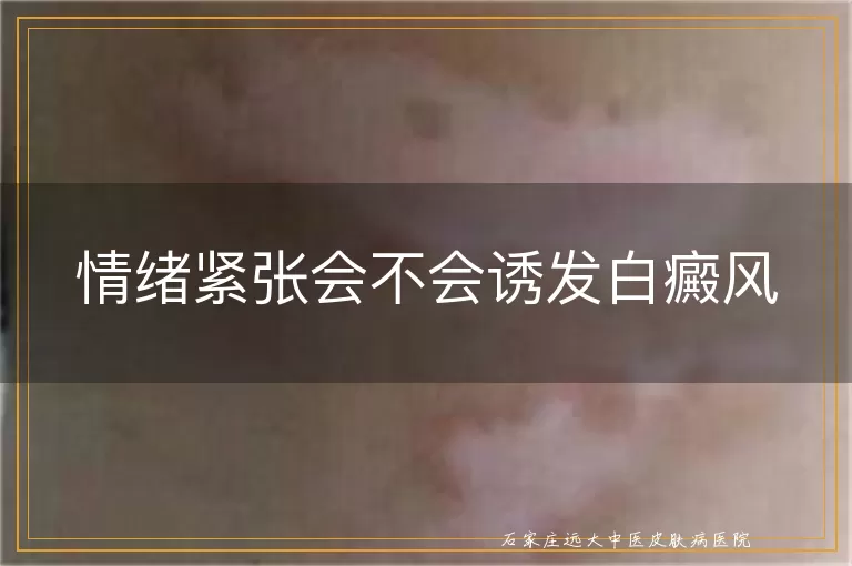 情绪紧张会不会诱发白癜风