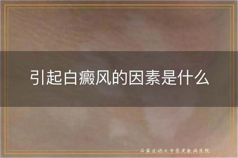 引起白癜风的因素是什么