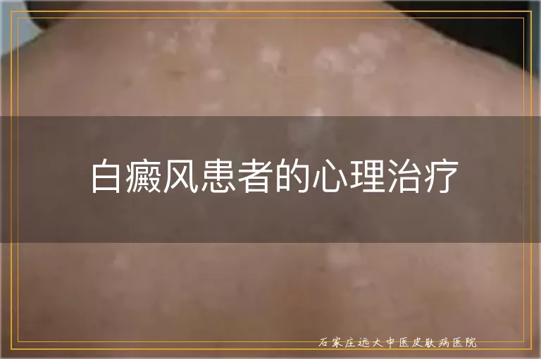 白癜风患者的心理治疗