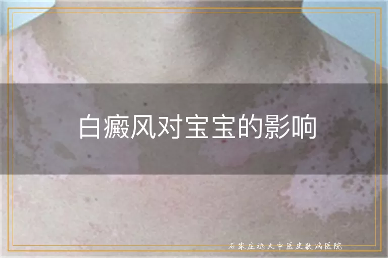 白癜风对宝宝的影响