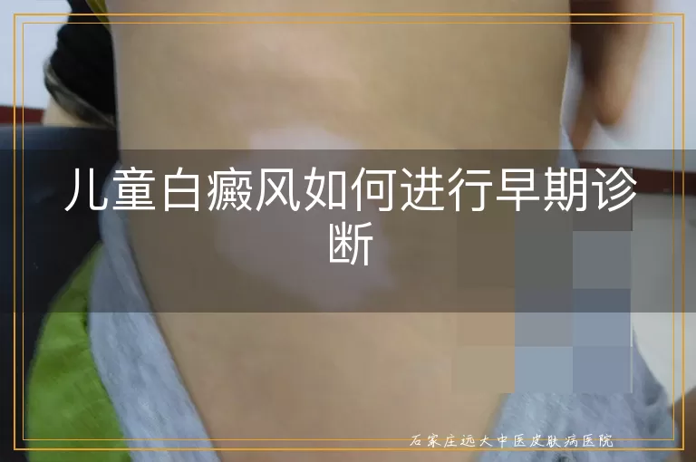儿童白癜风如何进行早期诊断