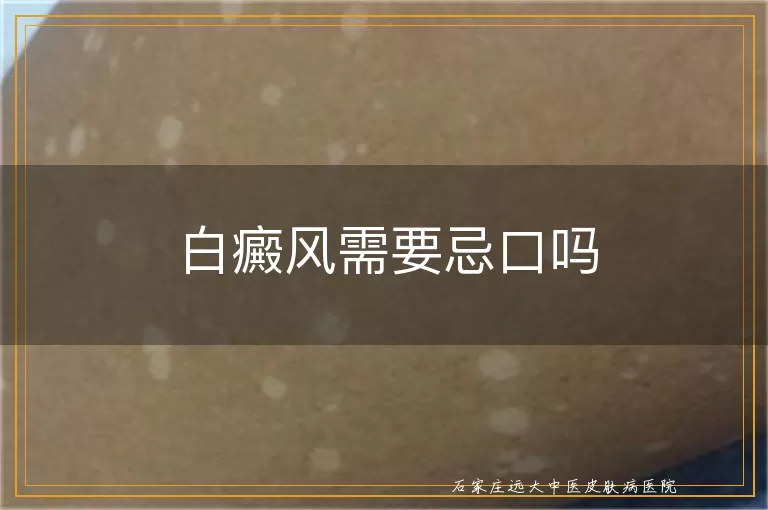 白癜风需要忌口吗
