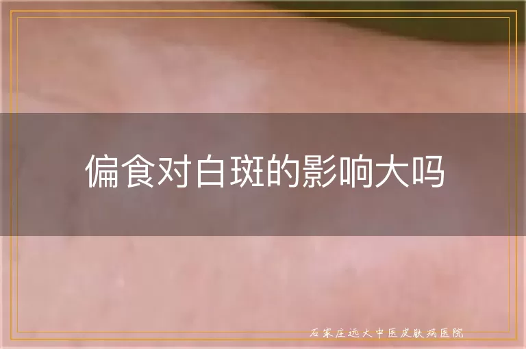偏食对白斑的影响大吗